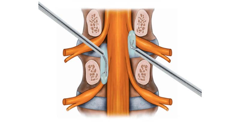 Endoscopia de Coluna: Tratamento de Doenças Vertebrais