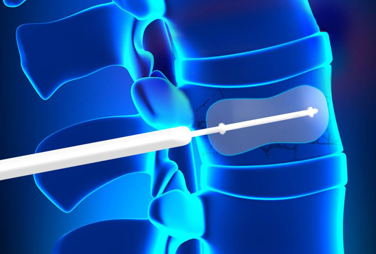 Cifoplastia