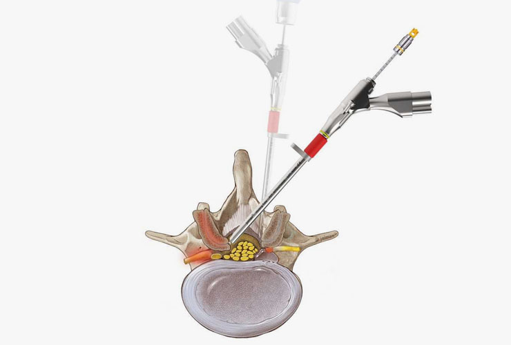 Discectomia Minimamente Invasiva